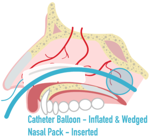 Epistaxis – Management – EMbeds.co.uk