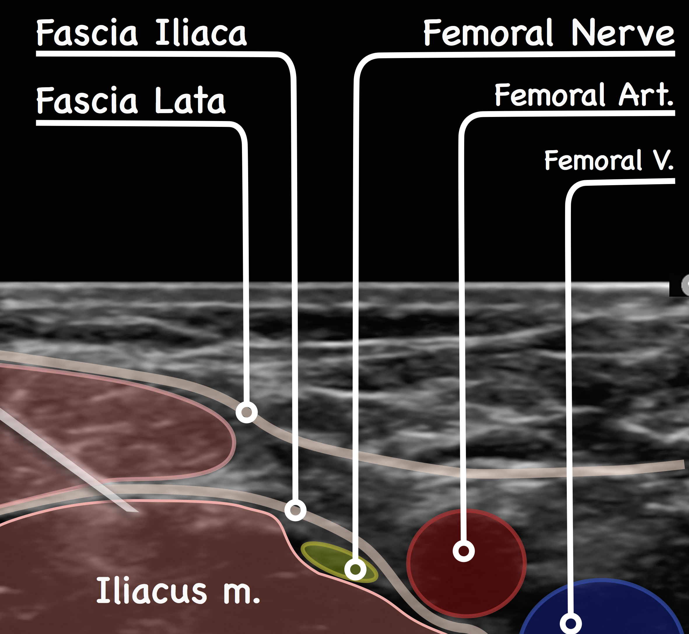 Ilioinguinal Nerve Block Ultrasound